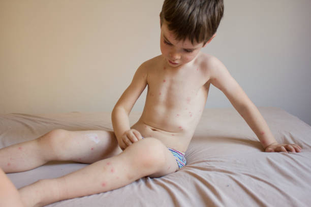 istock Those Chickenpox Are So Annoying 1182550717