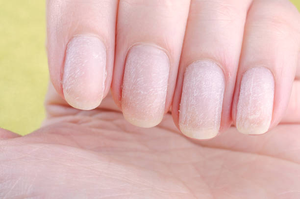 istock damaged nails after removing modern gel nail polish 1182693695