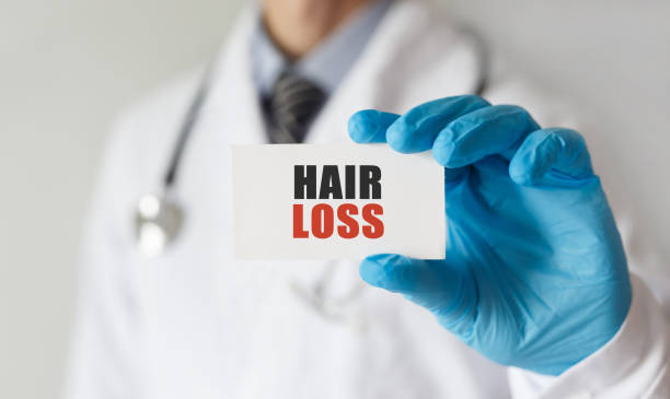 テキスト脱毛、医療コンセプトのカードを持つ医師 - 薄毛 ストックフォトと画像