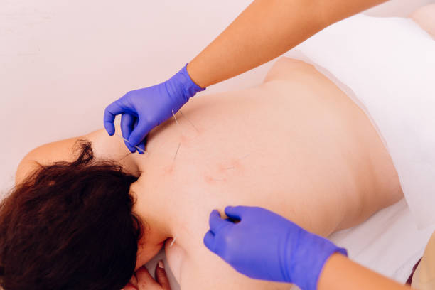 istock Physiotherapist doing acupuncture on woman's back 1182748888