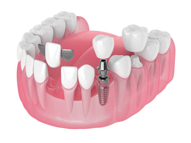istock 3d render of jaw with dental implants and bridges over white 1182890751