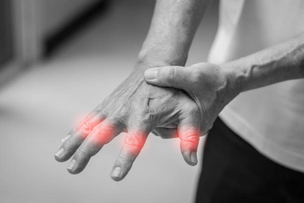 tendinitis uso excesivo de problemas de manos. mano de anciano con manchas rojas o dedos como sufren de síndrome del túnel carpiano. los síntomas de hormigueo, entumecimiento, debilidad o dolor de los dedos y la muñeca. - pain joint human hand arthritis fotografías e imágenes de stock