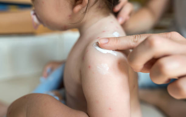 istock Mother applying healing cream on varicella rash 1183048880