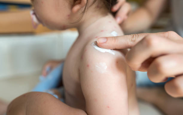 Mother applying healing cream on varicella rash Close-up image of mother’s hand putting healing cream on varicella bumps shingles rash stock pictures, royalty-free photos & images