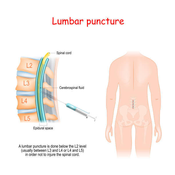 Lumbar Puncture Spinal Tap Procedure Stock Illustration - Download Image  Now - Spine - Body Part, Puncturing, Cerebrospinal Fluid - iStock