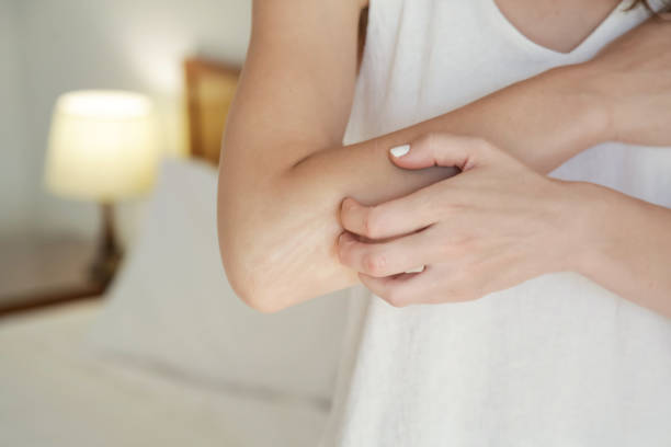 Winterizing dry itchy skin on the elbow area stock photo