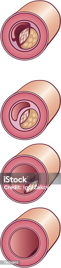 Cholesterin in Vene - Lizenzfrei Arteriosklerose Vektorgrafik