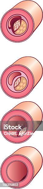 Cholesterin In Vene Stock Vektor Art und mehr Bilder von Arteriosklerose - Arteriosklerose, Cholesterin, Computergrafiken