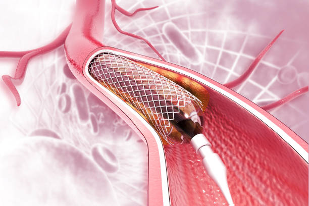 stent-angioplastie auf wissenschaftlichem hintergrund - angioplasty stock-fotos und bilder