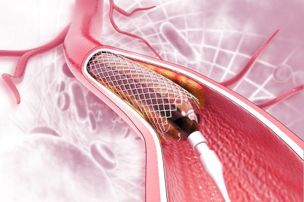 angioplastie de stent sur le fond scientifique - angioplasty photos et images de collection