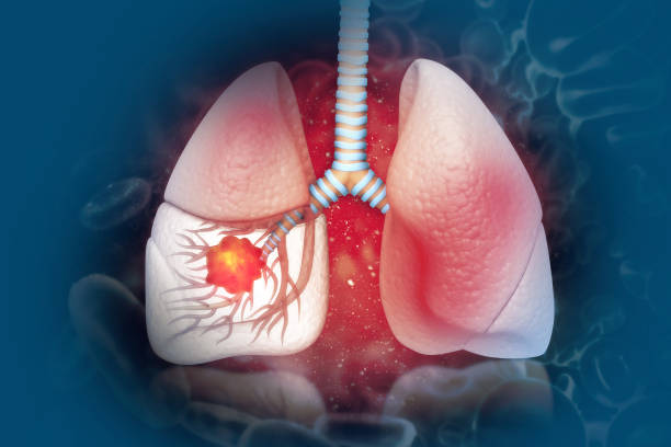 câncer de pulmão. doença pulmonar - illness x ray image chest x ray - fotografias e filmes do acervo