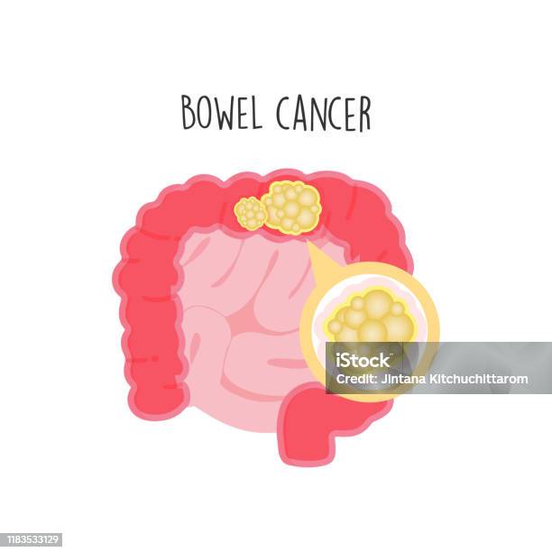 Bowel Cancer Flat Vector Illustration Stock Illustration - Download Image  Now - Cancer Cell, Cartoon, Anatomy - iStock