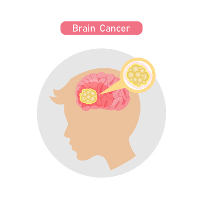 Brain Cancer Vector Brain Cancer Diagram Vector Illustration In Flat Style Stock ...