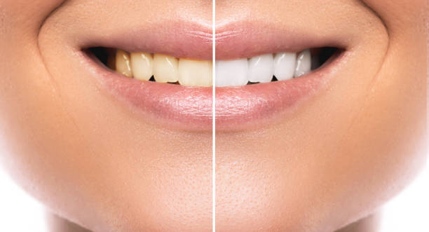comparaison après le blanchiment des dents - dental equipment chair dentist office dentists chair photos et images de collection