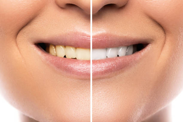 comparaison après le blanchiment des dents - dentist office dentists chair dentist dental hygiene photos et images de collection