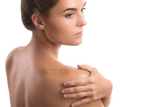 Woman with a scar on her shoulder stock photo