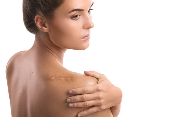 Woman with a scar on her shoulder Woman with a scar on her shoulder over white background scar stock pictures, royalty-free photos & images