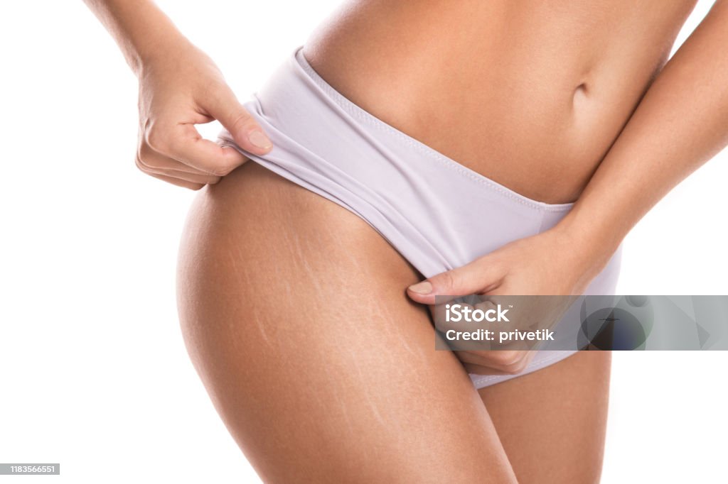 Female hips with a stretch marks Close up of female hips with a stretch marks Stretch Mark Stock Photo