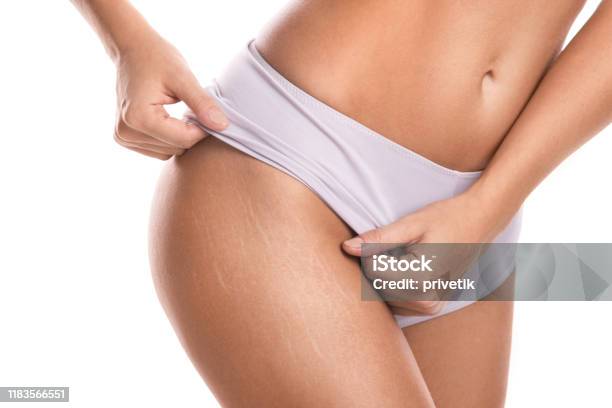 Female Hips With A Stretch Marks Stock Photo - Download Image Now - Stretch Mark, Scar, The Human Body