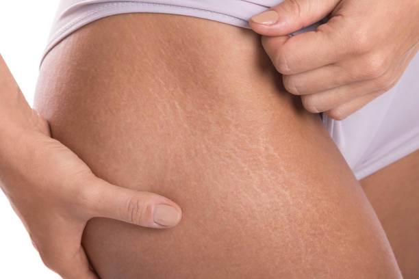 Female hips with a stretch marks stock photo