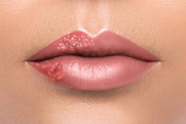 Female lips affected by herpes virus stock photo