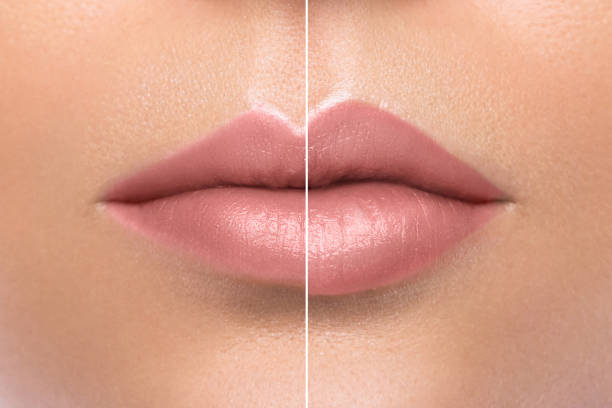 Comparison of female lips after augmentation stock photo