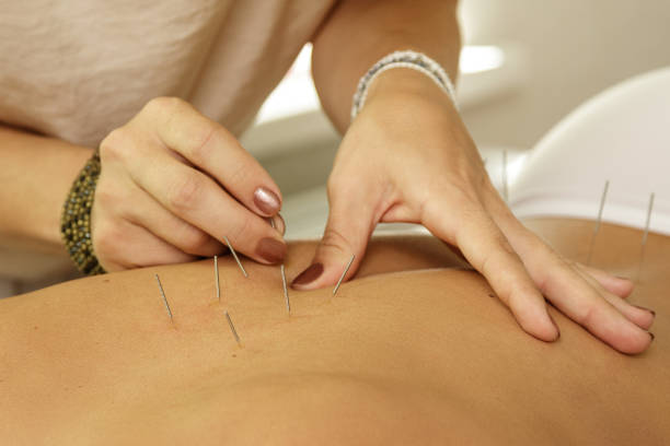 istock Master is injecting steel needles during procedure of acupuncture therapy 1183586256