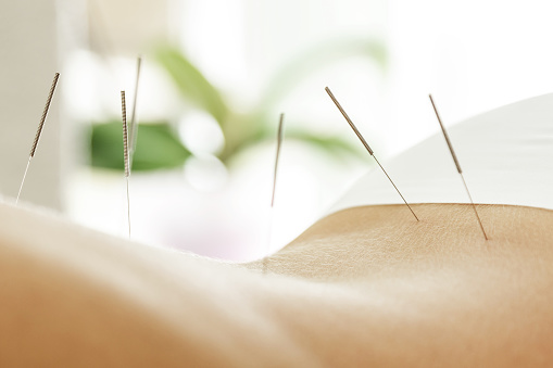 Espalda femenina con agujas de acero durante el procedimiento de terapia de acupuntura photo