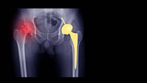 фильм рентгеновский рентген показывает аваскулярный некроз (avn) или остеонекроз (on) болезни и артрит сустава. левое бедро лечится общей хиру - tha стоковые фото и изображения