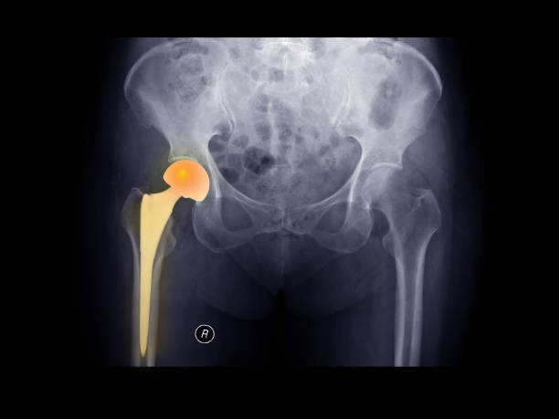 フィルムx線股関節x線は、股関節置換手術(血中形成術)によって治療された右股関節骨折(大腿骨骨折)を示す。義足デバイス上でハイライト。左股関節は正常な骨を示す。 - human spine anatomy x ray the human body ストックフォトと画像