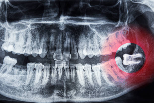 dentes de raio-x e dente do siso - dentist pain human teeth toothache - fotografias e filmes do acervo