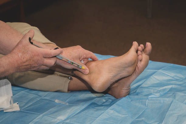 anestesia local para cirurgia no pé. - podiatry human foot podiatrist surgery - fotografias e filmes do acervo