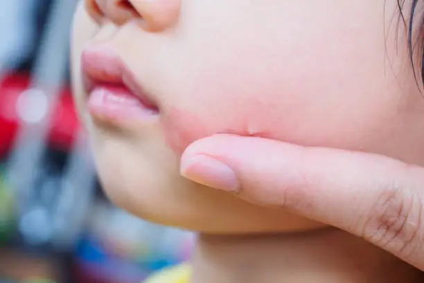 Photo of mother applying topical antihistamine cream at kid face with skin rash and allergy with red spot cause by mosquito bite