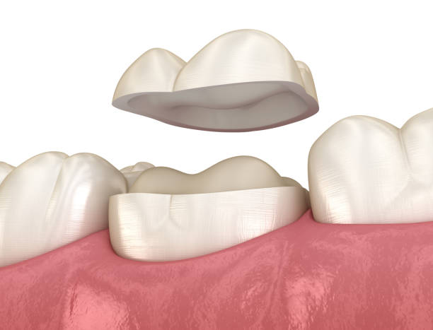 istock Onlay ceramic crown fixation over molar tooth. Medically accurate 3D illustration of human teeth treatment 1183878758