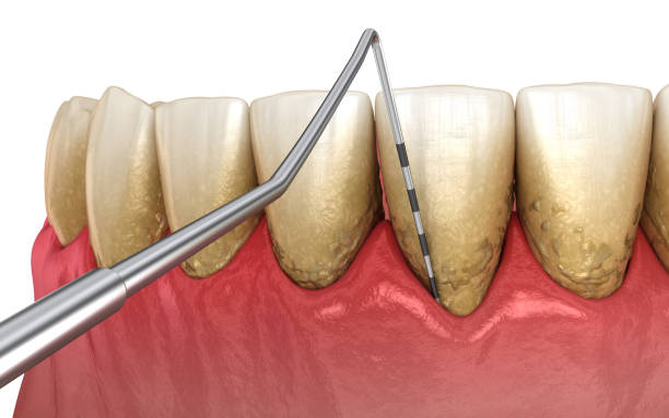 istock Periodontitis testing, gum recession process. Medically accurate 3D illustration 1183878772