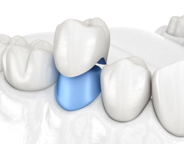 istock Porcelain crown placement over premolar tooth. Medically accurate 3D illustration 1183878843