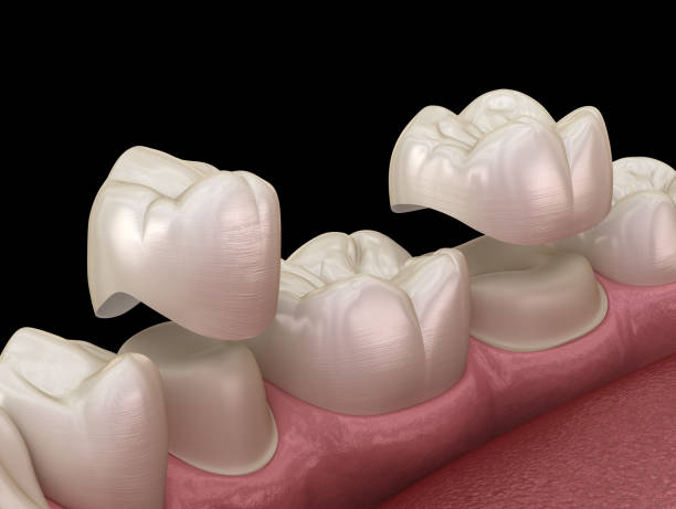 istock Porcelain crowns placement over premolar and molar teeth. . Medically accurate 3D illustration 1183878908