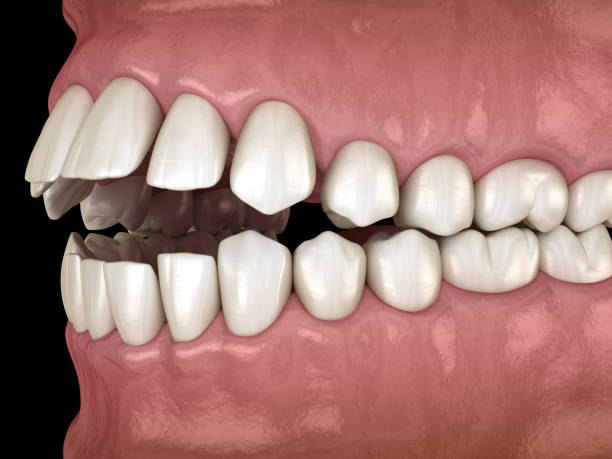 istock Openbite dental occlusion ( Malocclusion of teeth ). Medically accurate tooth 3D illustration 1183878925