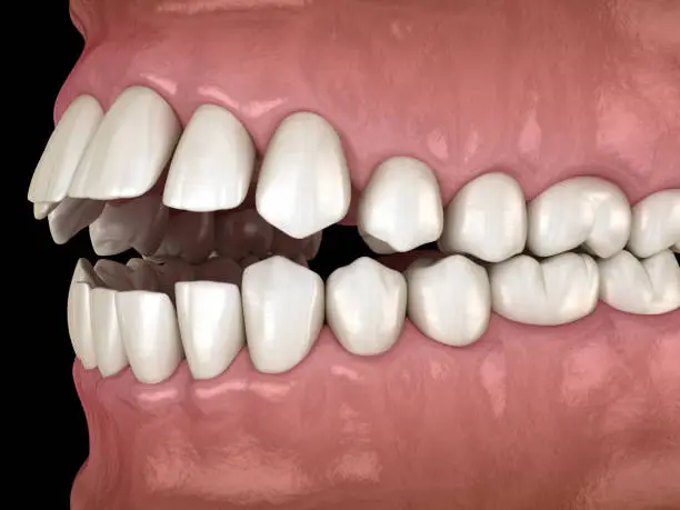 Photo of Openbite dental occlusion ( Malocclusion of teeth ). Medically accurate tooth 3D illustration