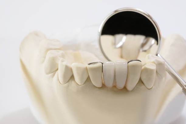 istock Dental maryland bridge. 1183920303