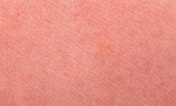 istock Sunburn skin as a texture or background. Selective focus. Extreme macro 1183924888