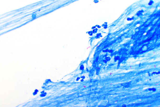 istock Acid-fast bacilli positive (small red rod) in sputum smear 1183978988