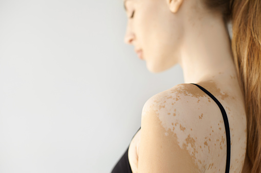 People, dermatology, cosmetology and skin condition concept. Side view of attractive young Caucasian female wearing black bra showing white vitiligo spots. Selective focus on woman's shoulder