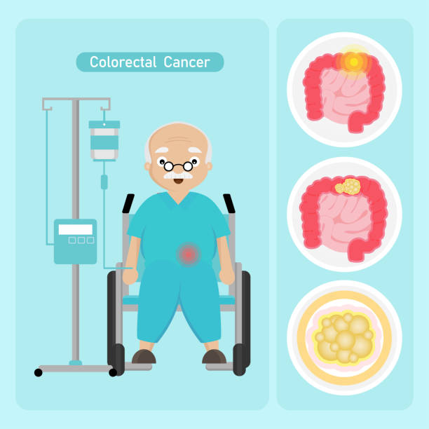 Senior man Patient with Coloreactal Cancer in cartoon style. Senior man Patient with Coloreactal Cancer in cartoon style. colon cancer screening stock illustrations