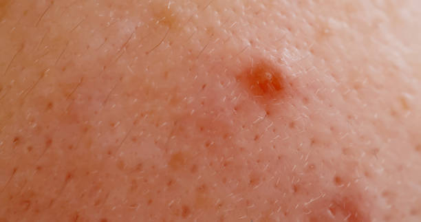 istock acne on the woman face 1184183706