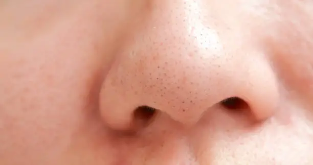 close up of blackheads on asian woman noseclose up of blackheads on asian woman noseclose up of acne on the woman face