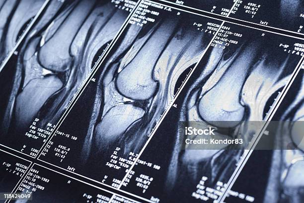 My フルニー Mri 損傷のクロス型靱帯 - X線撮影のストックフォトや画像を多数ご用意 - X線撮影, MRI検査, レントゲン