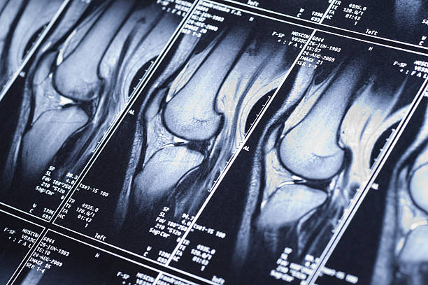 Knee MRI showing damage of the cross-shaped ligaments My knee MRI - sport trauma, damage of cross-shaped ligaments human knee stock pictures, royalty-free photos & images