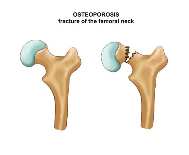 대퇴골 목의 골절. 골 합성 - orthopedic equipment osteoporosis x ray human spine stock illustrations