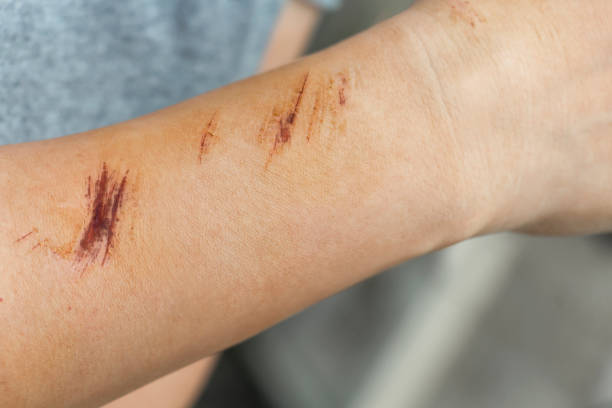 istock The wound form scabs on hand and arm. The wound happen during woman Injuries from falling down on road. 1184357319